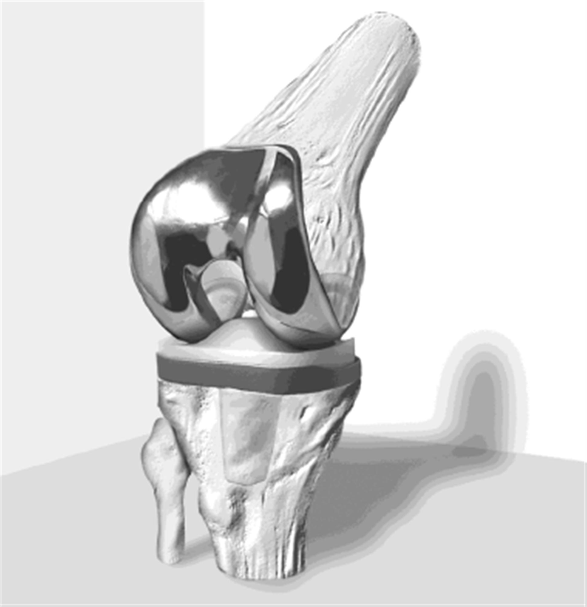 TKA Prosthesis Design Recon Orthobullets